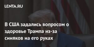 Здоровье Трампа под вопросом: синяки на руках вызывают беспокойство